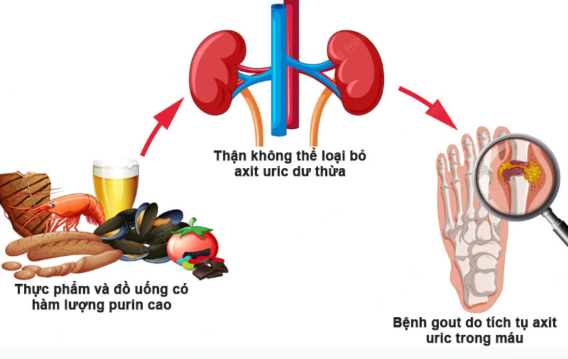 axit uric cao kiêng ăn gì để không bị gout