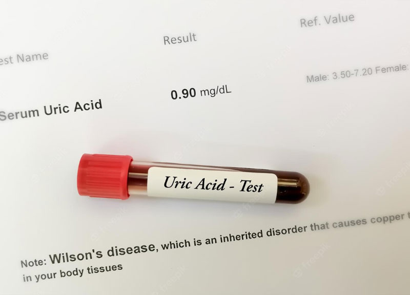 Xét nghiệm axit uric là gì