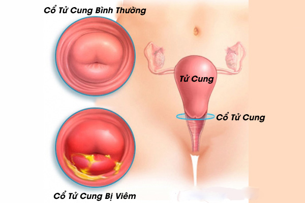 viêm lộ tuyến cổ tử cung có nguy hiểm không